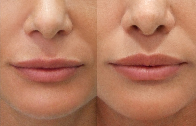 Usne prije i poslije lip lifta
