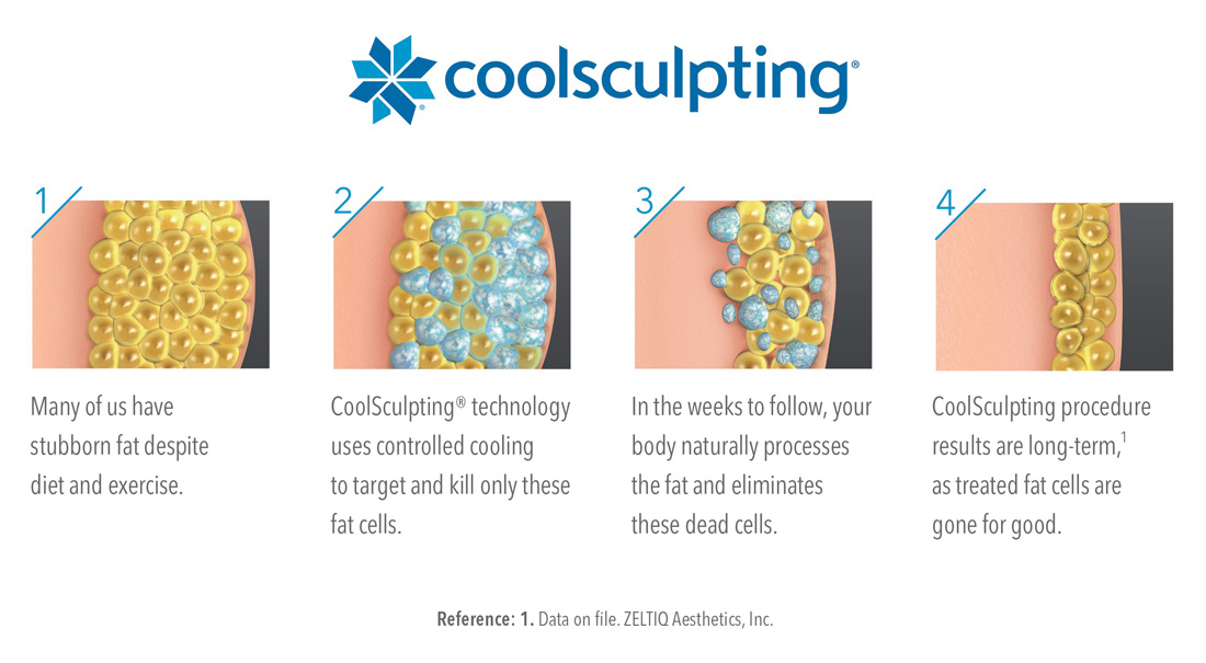 coolsculpting-2