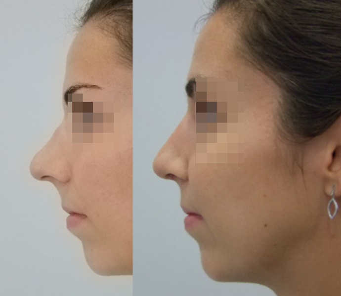 Ivanin nos prije i poslije